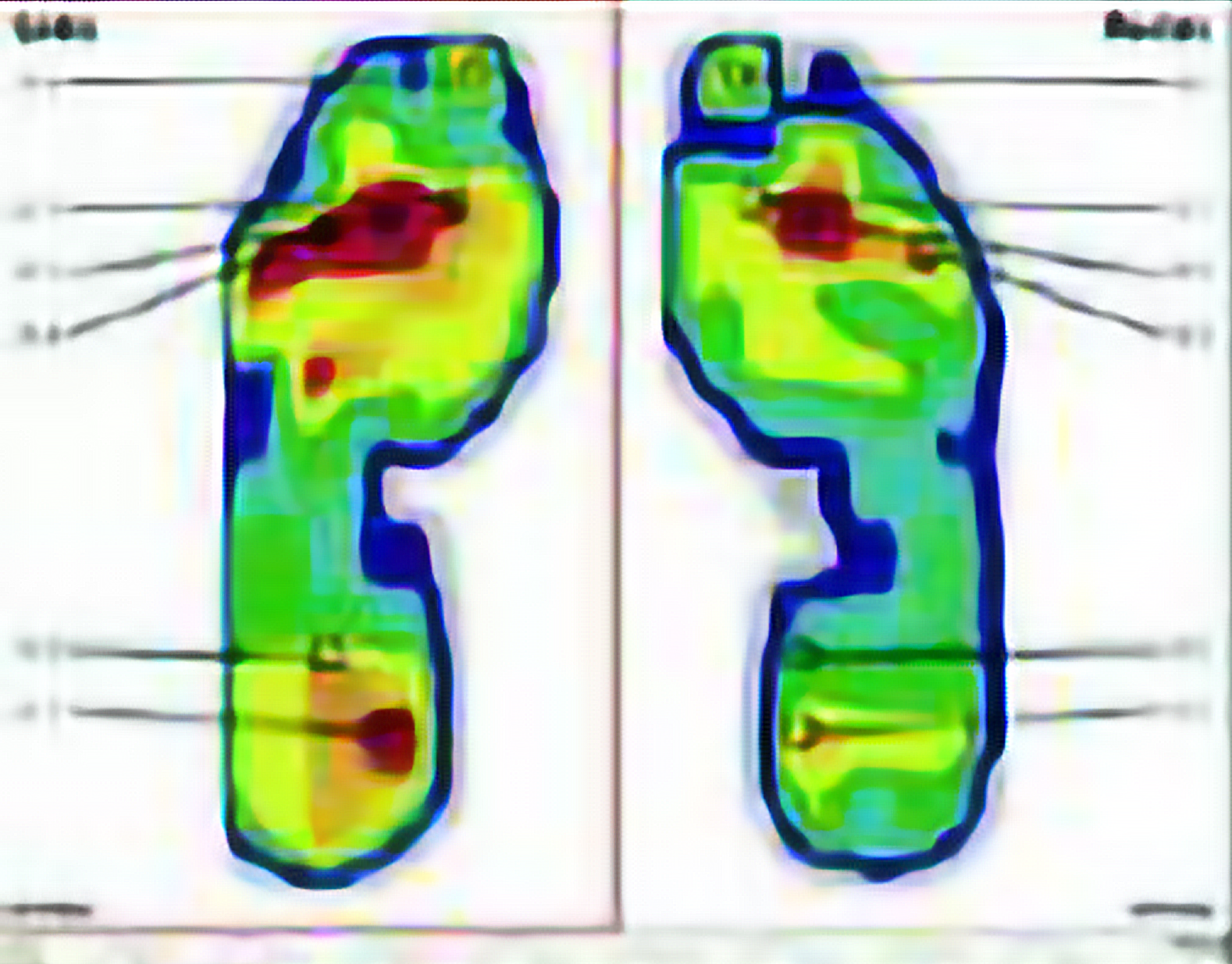 Individuell angepasste Sport-Einlagen